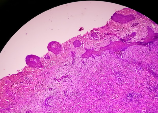 Biopsia cutanea al microscopio suggestiva di carcinoma a cellule basali, il tipo più comune di cancro della pelle