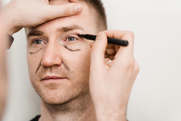 Blefaroplastica maschile del primo piano per il markup dell'uomo sul viso prima dell'operazione di chirurgia plastica per modificare la regione dell'occhio in clinica medica