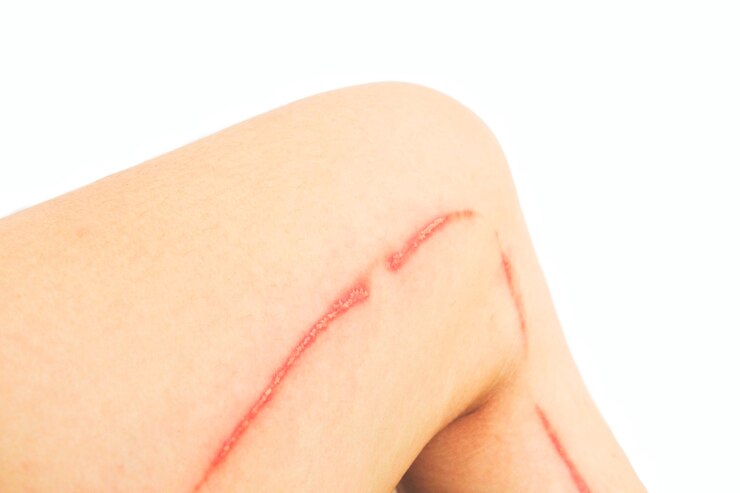Blisters caused by rove beetles (Paederus fuscipes Curtis) on leg. 