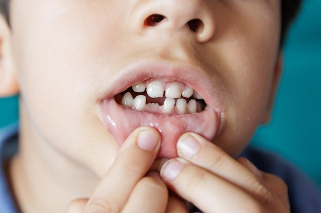 Bocca del bambino con ammaccatura dovuta al dente da latte caduto