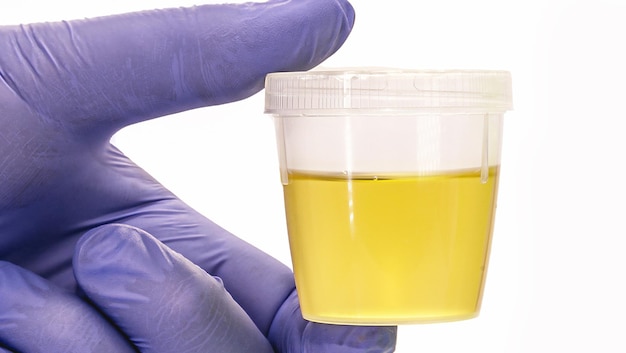 bottiglia di raccolta delle urine tenuta da una mano guantata blu Test delle urine EAS Urina per testo e controllo medico isolato sfondo bianco copyspace