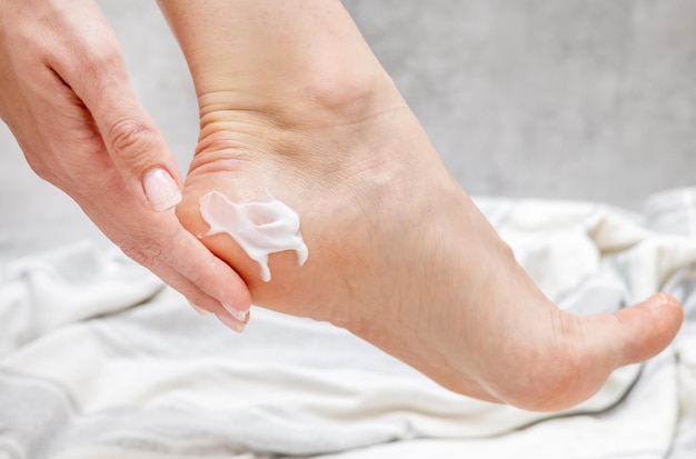 calli e duroni piede femminile piedi conseguenza di indossare scarpe scomode disturbi dermatologici