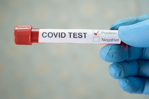 Campione di infezione del sangue positivo in provetta per covid19 coronavirus in laboratorio