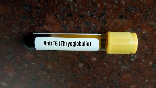 Campione di sangue isolato per test Anti tireoglobulina o Anti TG