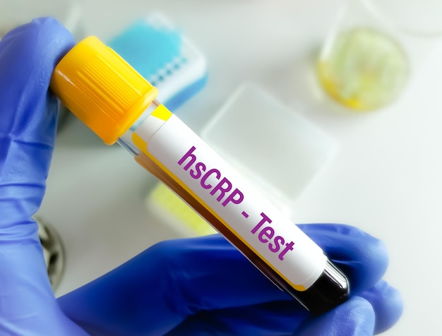 Campione di sangue per hsCRP test CRP ad alta sensibilità per la diagnosi di cardiopatie infiammatorie