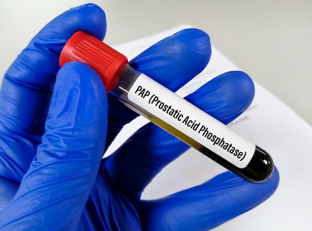 Campione di sangue per il test della fosfatasi acida prostatica in laboratorio per la diagnosi del cancro alla prostata