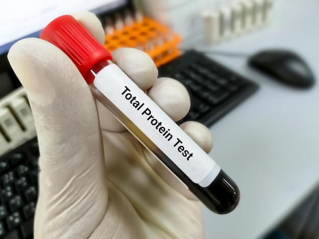 Campione di sangue per il test della funzionalità epatica del test delle proteine totali