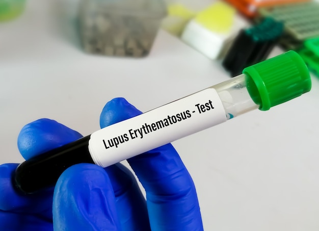 Campione di sangue per Lupus Erythematosus o test LE, una malattia autoimmune.