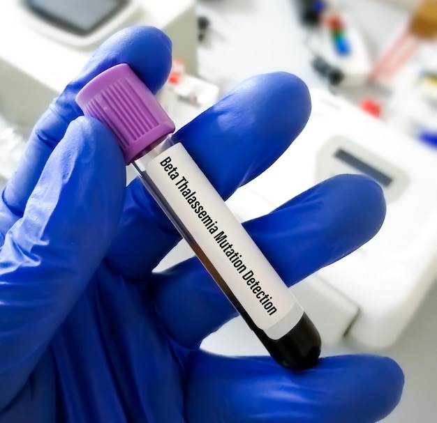 Campione di sangue per test di mutazione della beta talassemia in laboratorio PCR