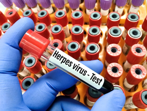 Campione di sangue positivo con il test PCR del virus dell'herpes.