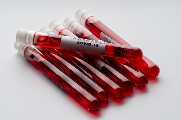 Campioni di analisi del sangue per il virus COVID 19