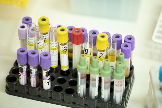 Campioni di sangue nel rack. Diagnostica di laboratorio analisi biochimiche, HIV, ausili, virus
