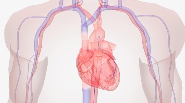 Catetere nell'arteria coronaria vicino al setto