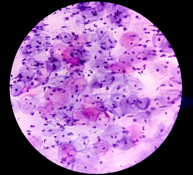 Cellule della cervice umana o cellule epiteliali squamose al microscopio per diagnosticare il cancro cervicale