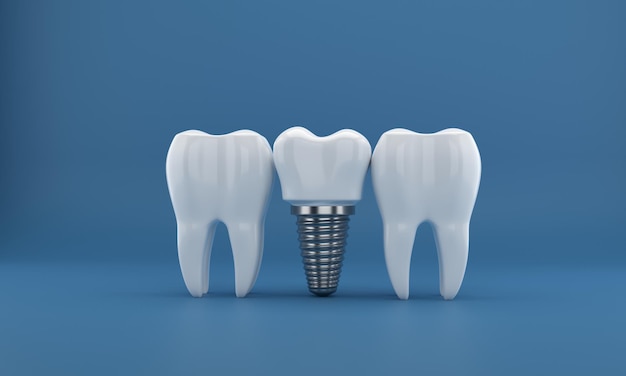 Chirurgia degli impianti dentali rendering 3d