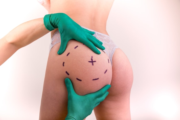 Chirurgo disegno segni sul corpo femminile prima dell'operazione plastica, superficie bianca
