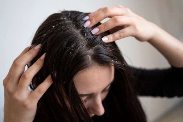 Chiuda in su donna con problemi di forfora