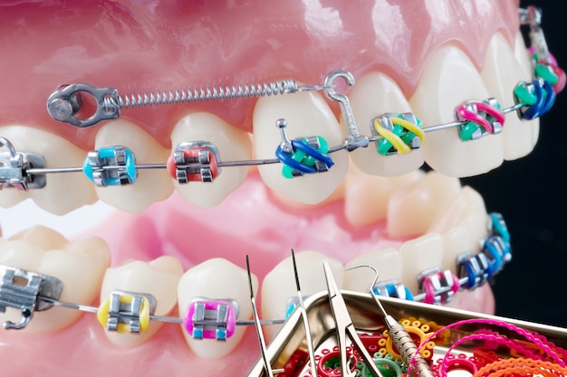 Chiuda sugli strumenti del dentista e sul modello ortodontico