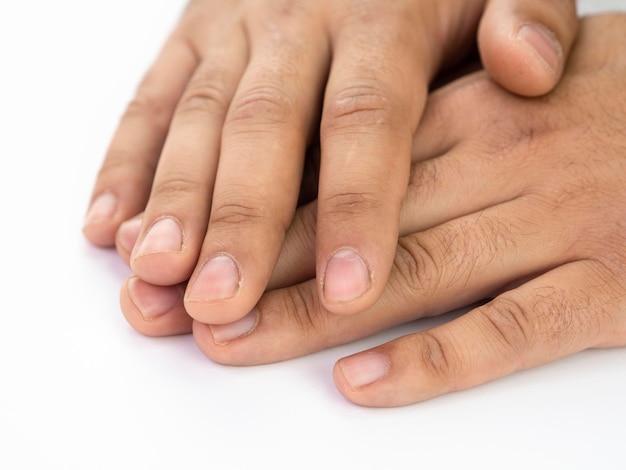 Chiuda sulle mani maschili bianche con il letto e la pelle danneggiati dell'unghia. Mostra i dettagli delle cuticole ferite. In attesa della procedura di manicure.