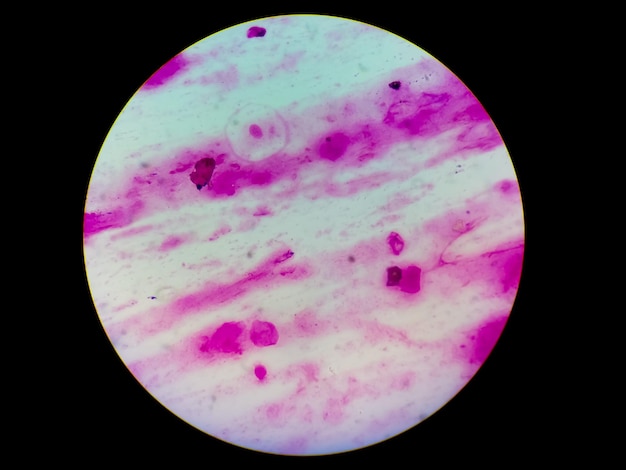 chiudere la vista dall'alto microscopica del carcinoma cellulare