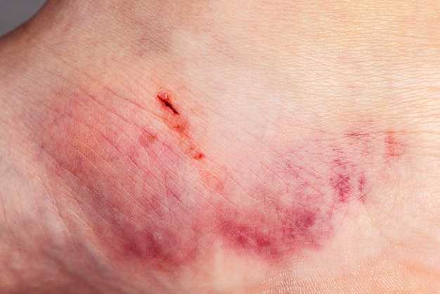 Close-up del livido sulla pelle della gamba di una donna ferita