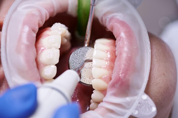 Close-up di un periodontista che utilizza strumenti dentali durante la pulizia dei denti del paziente Donna con un retrattore delle guance in bocca e apparecchi dentali sui denti che ricevono un trattamento dentale Concetto di igiene dentale professionale