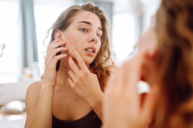 Close-up di una giovane donna che guarda i brufoli nello specchio Punti rossi eruzione cutanea acne trattamento della pelle