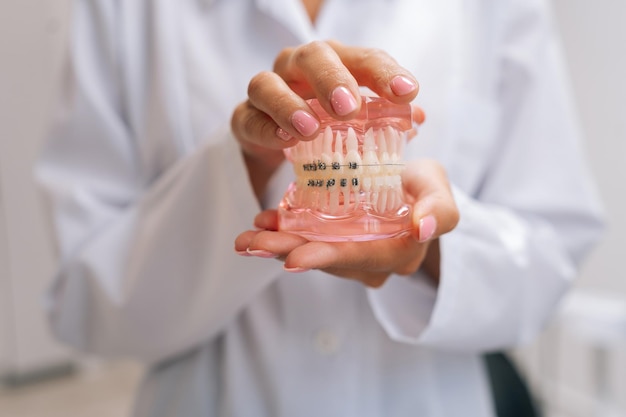 Closeup di mani irriconoscibili di una donna ortodontista in camice bianco che tiene le mascelle umane modello di layout con apparecchi dentali metallici in una clinica odontoiatrica vista frontale Concetto di ortodonzia stomatologica