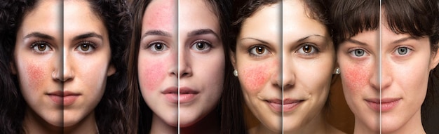 Collage di volti di donne che mostrano prima e dopo la rosacea