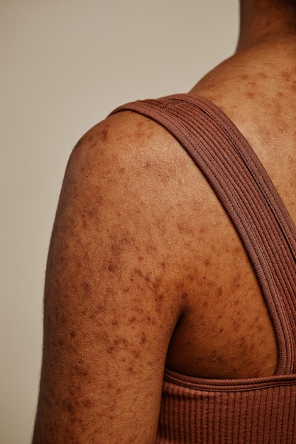 Colpo di dettaglio della struttura della pelle del corpo femminile e cicatrici da acne sulla schiena e sulle spalle