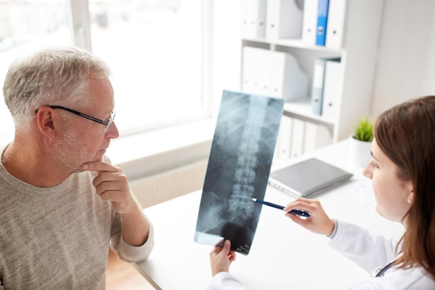 concetto di medicina, assistenza sanitaria, chirurgia, radiologia e persone - medico che mostra i raggi x della colonna vertebrale all'uomo anziano in ospedale