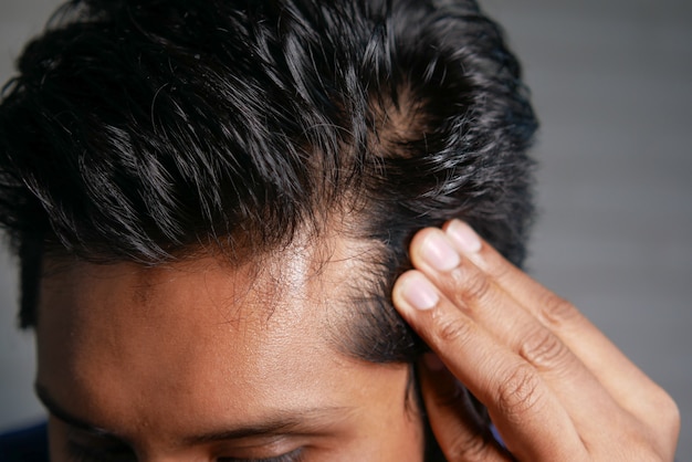 Concetto di perdita di capelli con l'uomo che controlla i suoi capelli