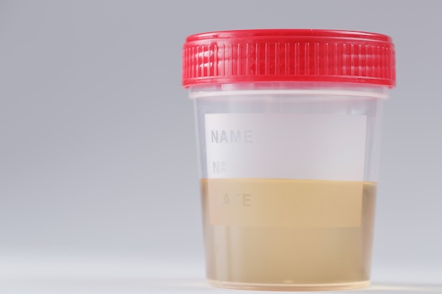 Contenitore in plastica con analisi delle urine gialle per rilevare malattie