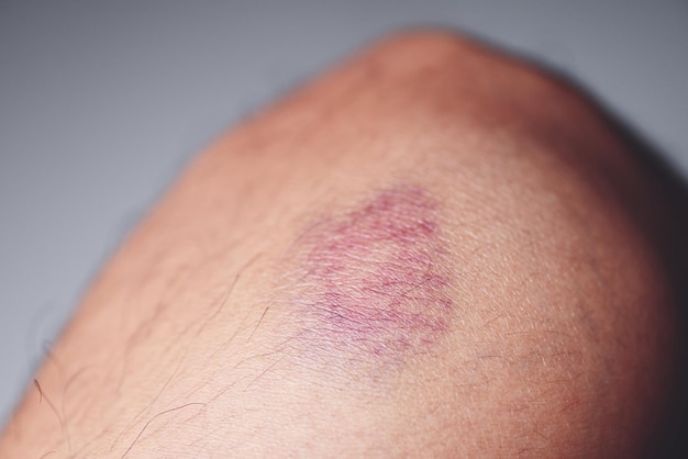 Contusione al ginocchio Ferita alla gamba contusa causata da sport e lesioni alle gambe da urti o cadute