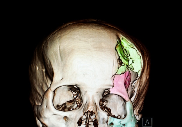 Cranio gravemente fratturato