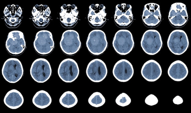 CT Brain Axial esegue la scansione della massa iperdensa con edema cerebrale perilesionale omogeneo e lieve nella regione fronttemporalparietale destra Si sospetta il meningioma Concetto di immagine medica