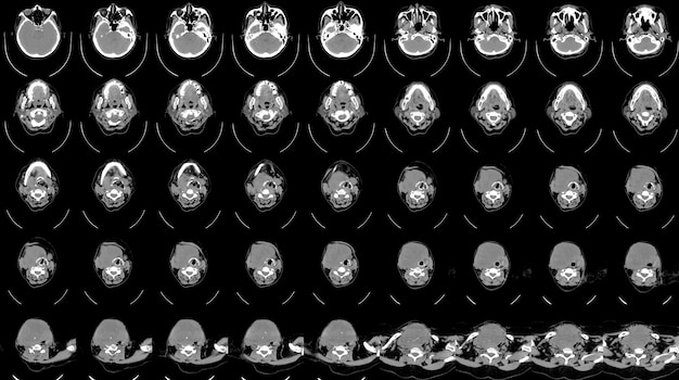 CT SCAN OF THE NECK HISTORY