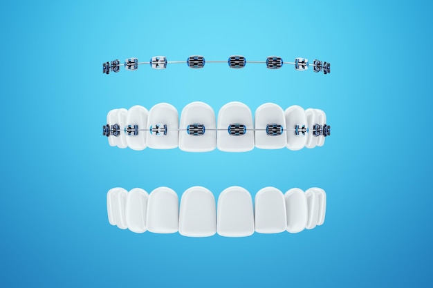 Denti bianchi con bretelle metalliche su sfondo blu. Apparecchi odontoiatrici, cure ortodontiche, odontoiatria, sbiancamento dei denti, protezione, igiene orale, igiene, sanità. Illustrazione 3D, rendering 3D.