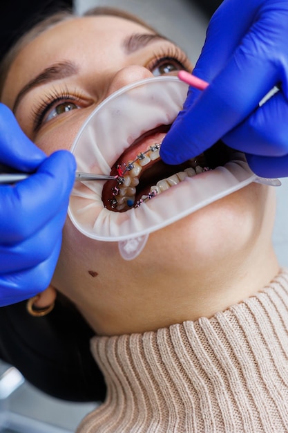 Denti della donna con le parentesi graffe sui denti bianchi. Un ortodontista utilizza strumenti dentali per posizionare le parentesi graffe sui denti di un paziente. Il concetto di odontoiatria, trattamento ortodontico. Messa a fuoco selettiva