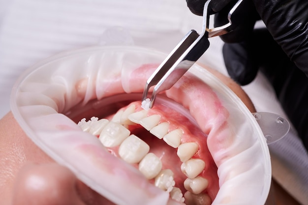 Dentista che fissa staffe ortodontiche ai denti del paziente