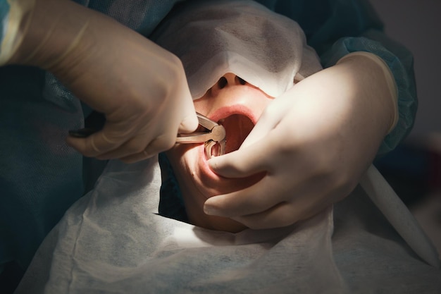 Dentista che utilizza pinze chirurgiche per rimuovere un dente in decomposizione nella stanza di stomatologia, primo piano