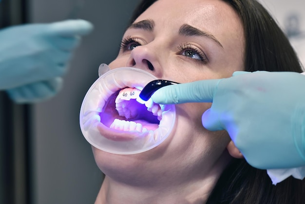 Dentista corregge le parentesi graffe con una lampada fotopolimerica