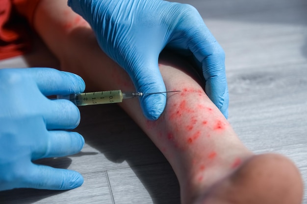 dermatite atopica sulle gambe di un trattamento infantile