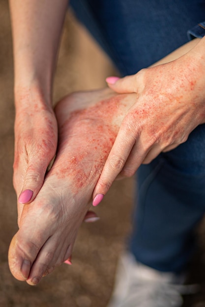 Dermatite da eczema su mani e piedi macchie rosse sulla pelle pelle secca