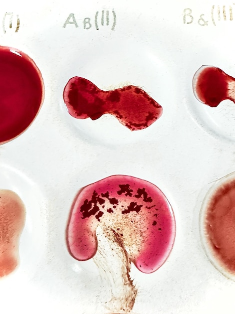 Determinazione della compatibilità dei gruppi sanguigni Reazione di agglutinazione Foto di alta qualità