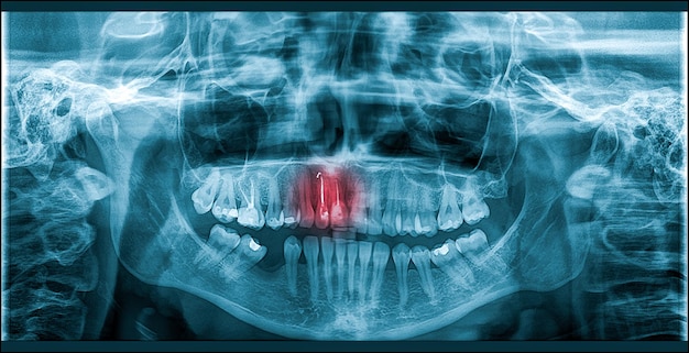 Dolore della carie sui denti Xray