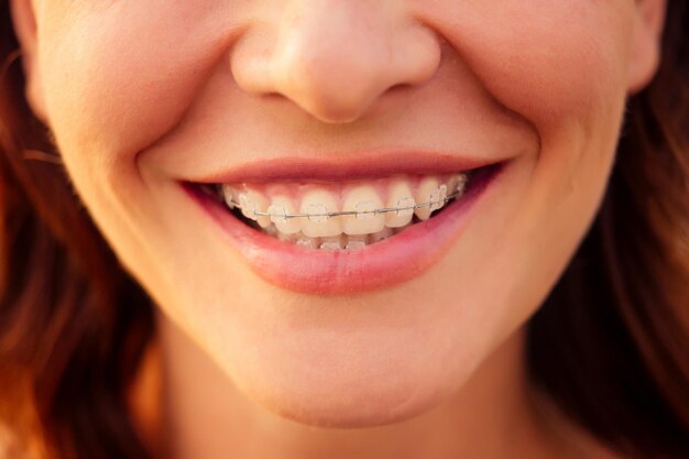 Donna, 30-35 anni sorridente a trentadue denti sorriso con bretelle sul fondo della spiaggia dell'oceano del mare.