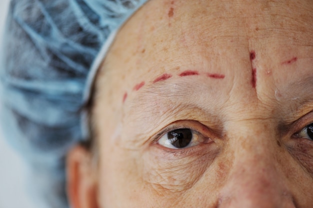 Donna anziana che ottiene la procedura di iniezione di Botox