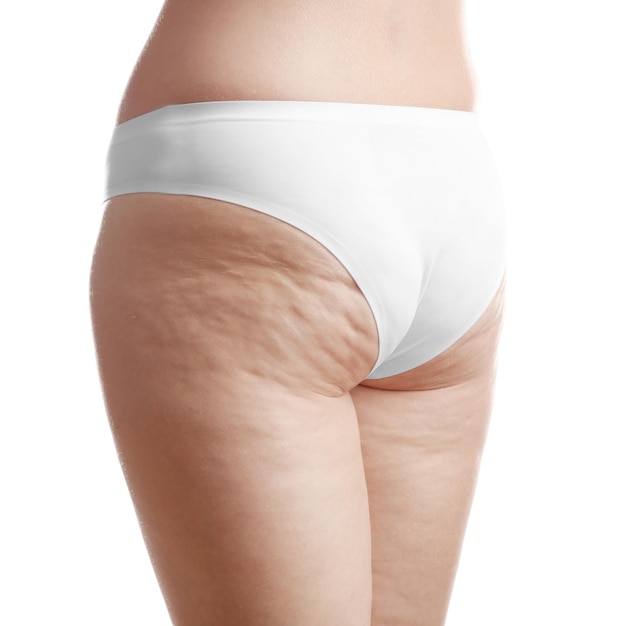 Donna con cellulite su glutei e gambe su sfondo bianco