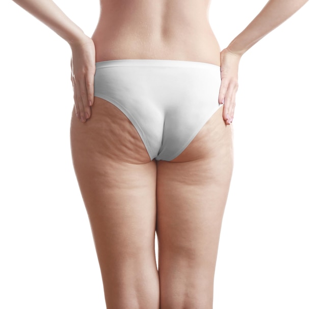 Donna con cellulite su glutei e gambe su sfondo bianco